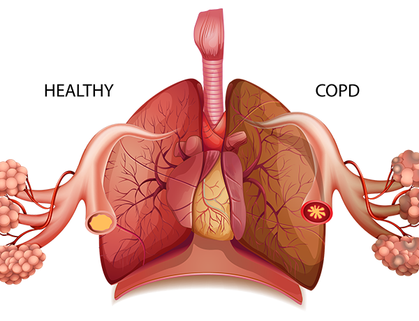 COPD