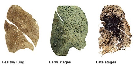 lung cancer from silica inhalation